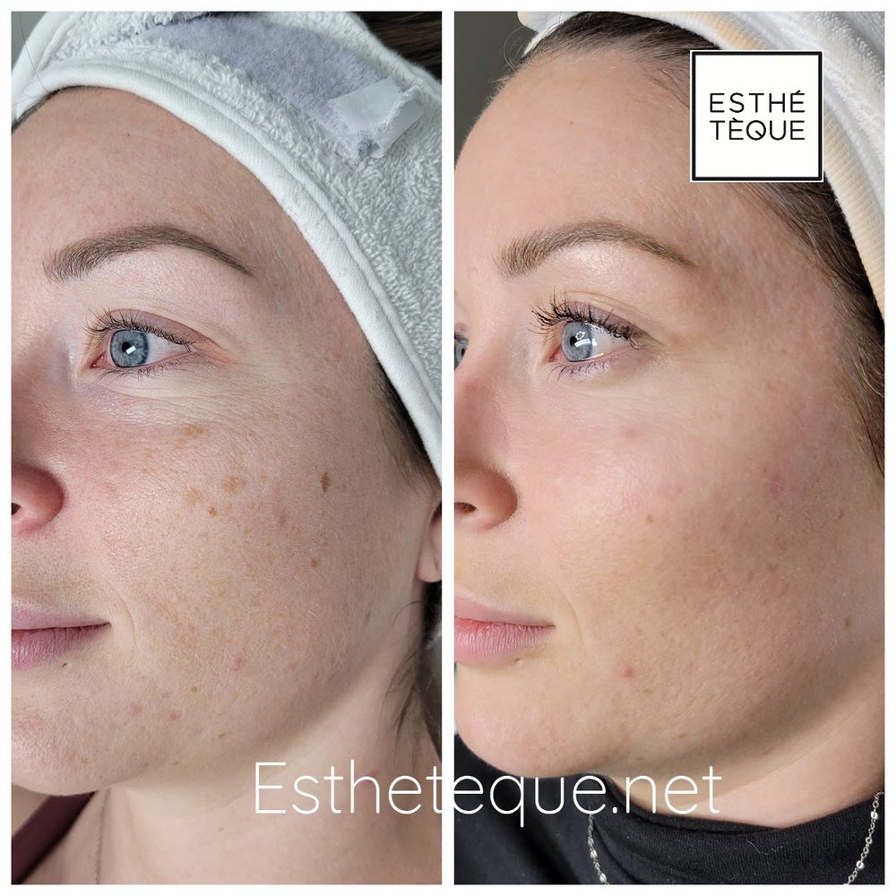 Avant et après une cure de rajeunissement par laser : contour des yeux et taches pigmentaires d'une cliente de la clinique